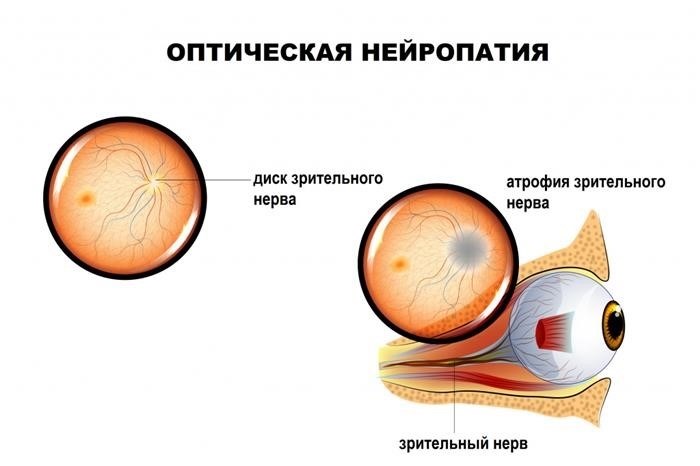 Ограничения в работе для людей с третьей группой нетрудоспособности