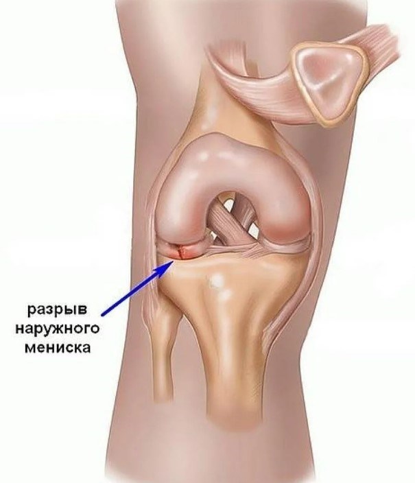 Разрыв мениска карта вызова